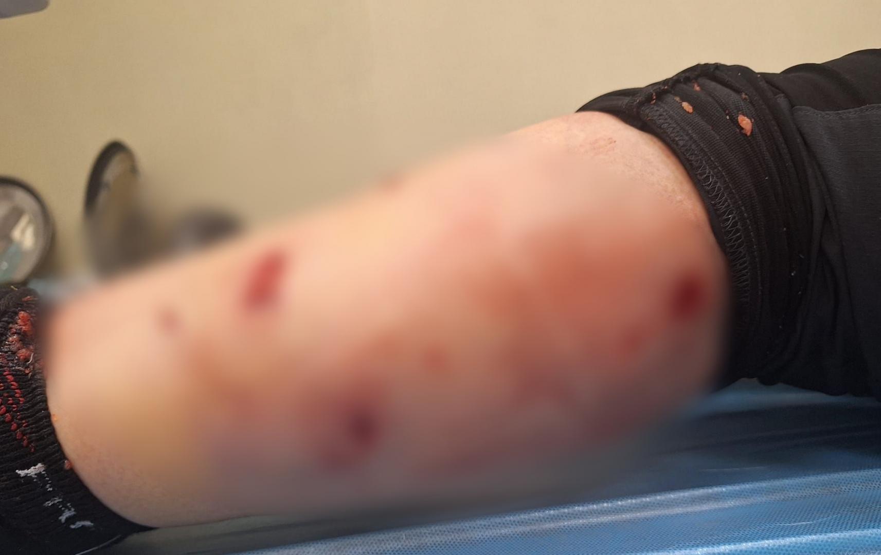 Atac brutal în Cluj: Femeie mușcată grav de o haită de câini. „Putea fi ucisă!"