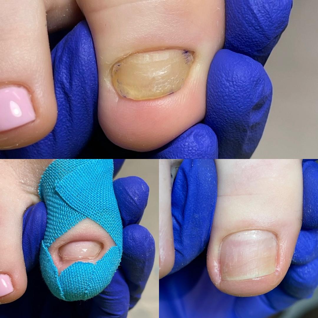 &bdquo;Nu tăiați colțurile unghiilor de la picioare, &icirc;n special la copii!''. Cum se rezolvă unghiile &icirc;ncarnate fără durere, la Antoaneta Tulbure Studio