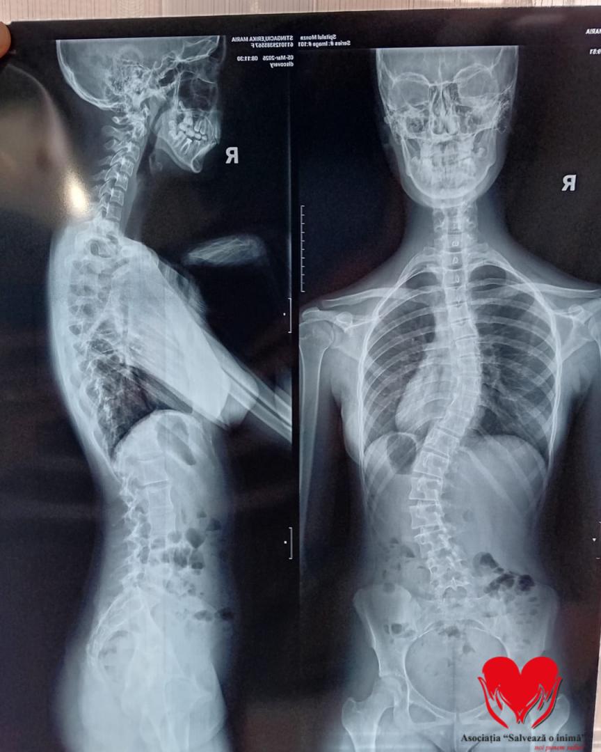 &bdquo;Fiecare zi &icirc;mi curbează coloana tot mai mult&rdquo;. Erika, o adolescentă de 15 ani, are nevoie urgent de o operație pentru a putea trăi fără durere
