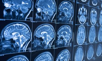 Un ''implant cerebral'' a fost utilizat în tratamentul bolii Parkinson în cadrul unui studiu de pionierat