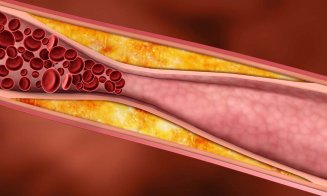 Colesterol „bun” vs „colesterol rău”. Ce alimente trebuie să mâncăm