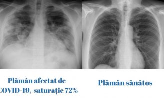 Cum arată plămânul unui tânăr de 23 de ani cu COVID, faţă de un plămân sănătos