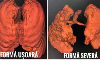 CNCAV a publicat tomografiile computerizate a unor pacienţi cu COVID, nevaccinaţi: „Nu vă jucaţi cu sănătatea!"