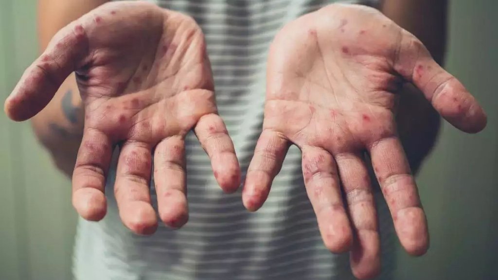 Ziua de Cluj | Încă un caz de variola maimuţei în România
