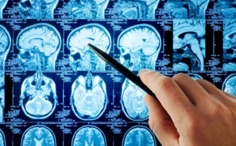 Tot mai mulți tineri diagnosticați cu tumori cerebrale. Care sunt cauzele