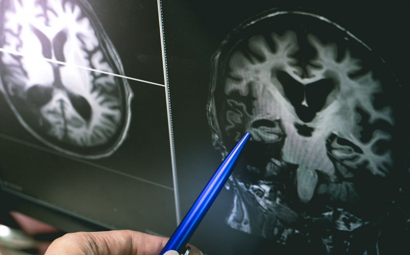 Au fost identificați peste zece factori-cheie de risc pentru demenţă. Aceștia pot prezice dacă persoana va dezvolta boala în următorii ani