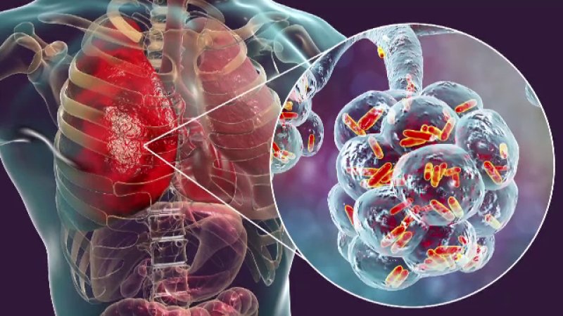 1 din 5 pacienţi cu GRIPĂ trebuie internat. Se pregătește declararea EPIDEMIEI