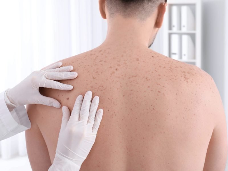 Cancerul de piele, tot mai des întâlnit la tineri. Persoanele cele mai expuse riscului de a dezvolta boala