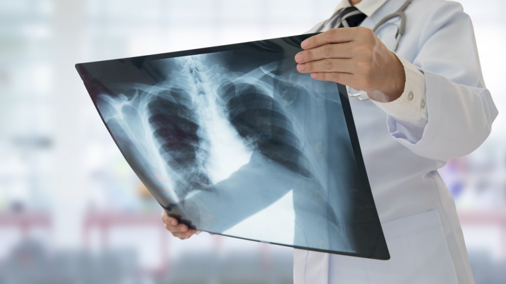 Ziua Mondială a Plămânilor. Peste 10.000 de români mor anual de cancer pulmonar