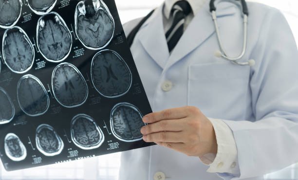 O terapie pentru o boală a creierului ar putea creşte riscul de cancer