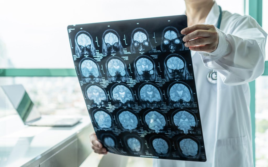 Aproape jumătate dintre persoane ar putea dezvolta demenţă după 55 de ani. Cum se poate reduce acest risc