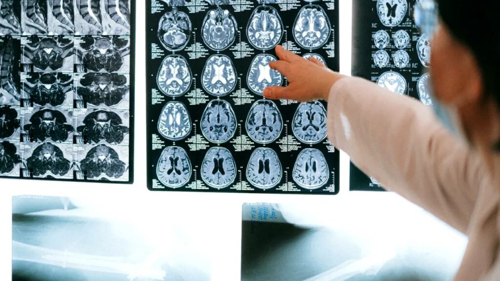 Prevenția AVC: 8 metode esențiale pentru a reduce riscul de accident vascular cerebral