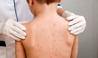 Aproape 2.500 de cazuri de rujeolă în ultima lună/ Problemele grave de sănătate pe care le poate da boala pe termen lung