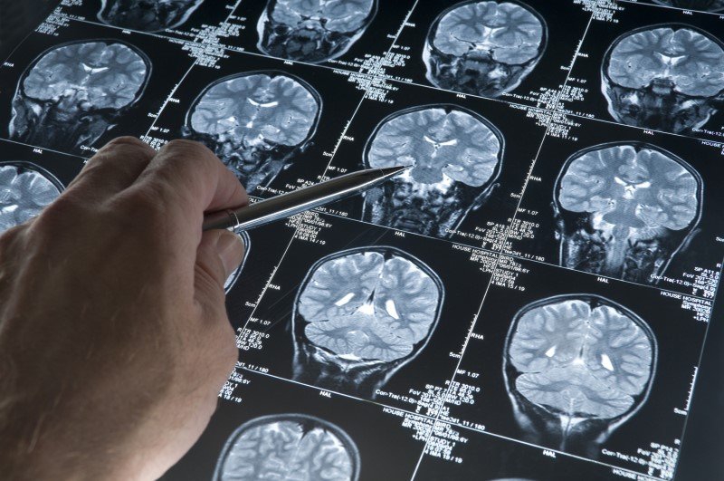 14 factori care pot reduce cu 45% cazurile de demență dacă știm cum să-i gestionăm