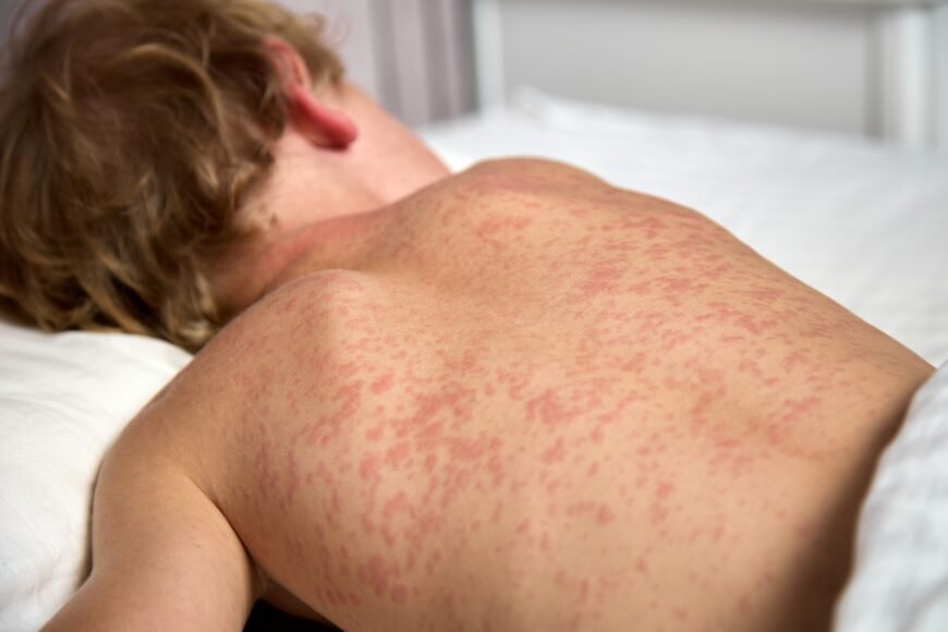 Peste 1.000 de cazuri de rujeolă înregistrate în ultima lună în România/ Urmările grave la care poate duce pojarul