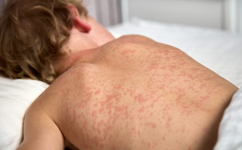 Peste 1.000 de cazuri de rujeolă înregistrate în ultima lună în România/ Urmările grave la care poate duce pojarul