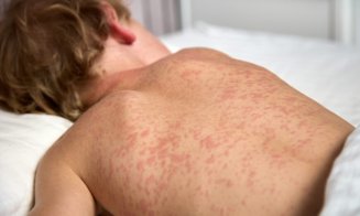 Peste 1.000 de cazuri de rujeolă înregistrate în ultima lună în România/ Urmările grave la care poate duce pojarul