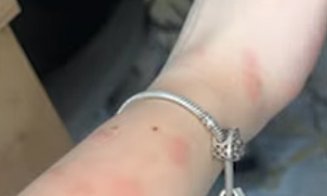 Ciuruită de ploșnițe la cușeta CFR Călători pe ruta București - Sighet / 13 ore în ”trenul groazei ”, la 190 de lei