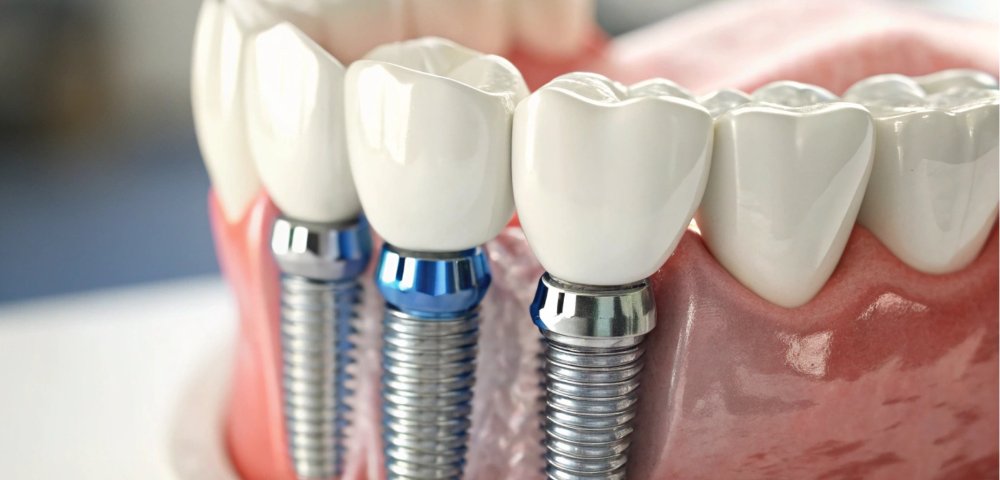 Implant dentar: ce trebuie să știi pentru o recuperare corectă și fără complicații