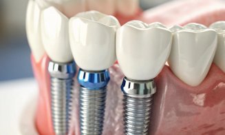 Implant dentar: ce trebuie să știi pentru o recuperare corectă și fără complicații