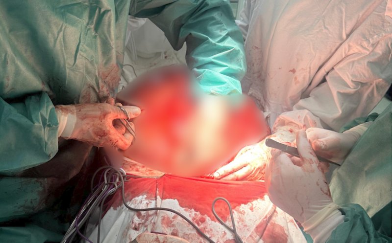 Intervenție spectaculoasă la SCJU Cluj! O echipă de chirurgi a îndepărtat o tumoră de 25 kg într-o operație de mare risc