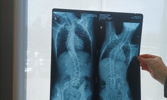 „Am 15 ani și am uitat cum e să nu te doară”. Mihai se luptă cu scolioza severă și are nevoie de o operație costisitoare, dar...