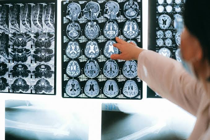 Descoperire uriașă în lupta cu Alzheimer. O proteină ar putea opri și chiar inversa afectarea creierului