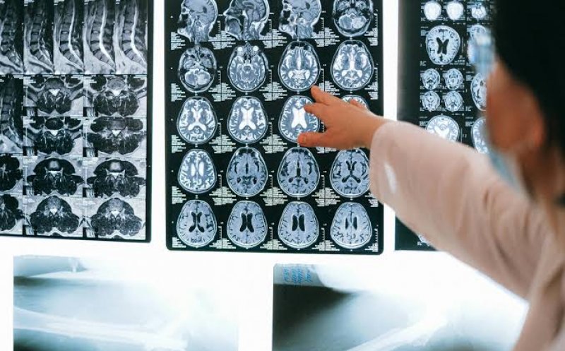 Descoperire uriașă în lupta cu Alzheimer. O proteină ar putea opri și chiar inversa afectarea creierului